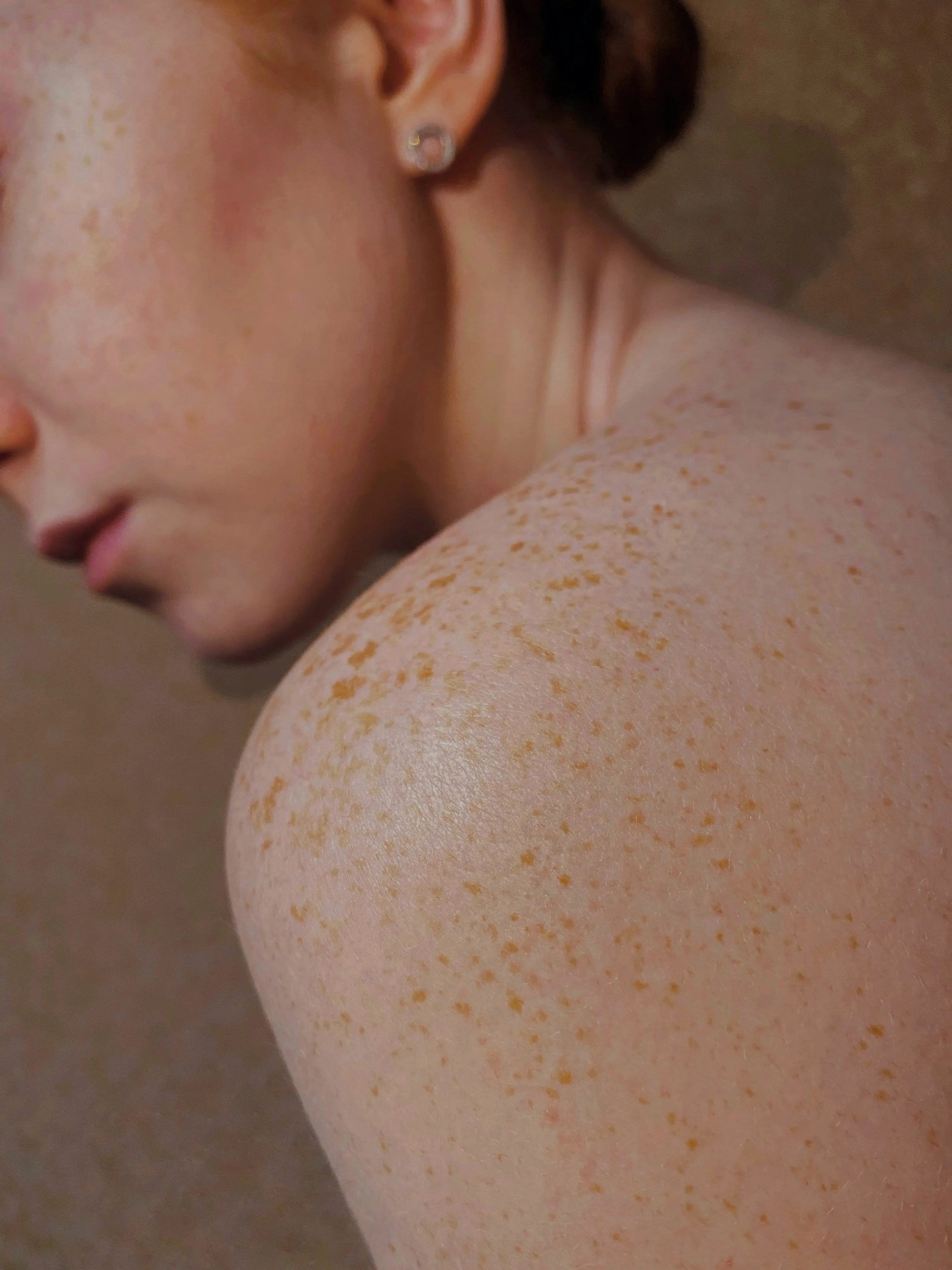 Ever wondered what causes dark spots and pigmentation on your skin